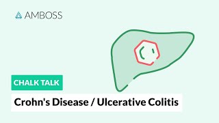 Crohn’s disease and ulcerative colitis Differences [upl. by Madaih672]