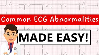 Common ECG abnormalities  MADE EASY [upl. by Ahsenek157]