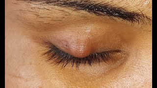 Chalazion Incision amp Curettage HD [upl. by Oicnerual158]