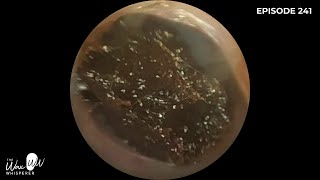 241  Ear Wax Removal in Stenotic Ear Canal using the WAXscope®️ [upl. by Keith]