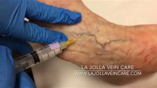 Highlighting the Best Sclerotherapy Techniques at La Jolla Vein and Vascular in 2024 [upl. by Vergne]