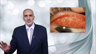 Elbromboly Basic ophthalmology IC Conjunctiva Conjunctivitis [upl. by Issej]