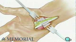 Carpal Tunnel Syndrome Repair Surgery [upl. by Nesto]