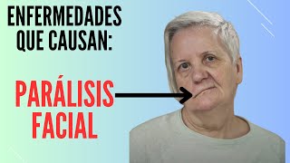 7 enfermedades que causan parálisis facial [upl. by Leroy457]