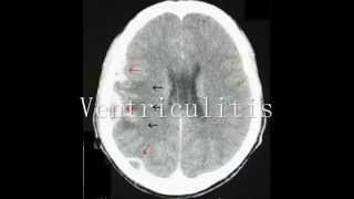 Intracranial Empyema and Ventriculitis Radiologic Features [upl. by Niccolo]