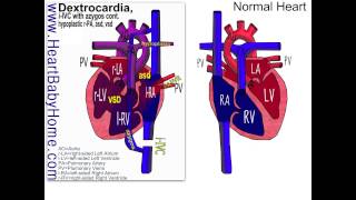 55 Dextrocardia PAPVR azygos continuation [upl. by Siari729]