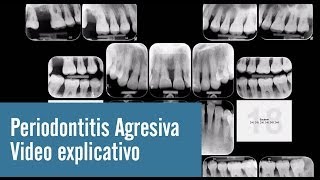 Periodontitis Agresiva  Video explicativo [upl. by Noemad]