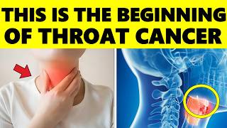 This is How Throat Cancer Starts And NO ONE Tells you – Signs and Symptoms of Throat Cancer [upl. by Lehcor701]