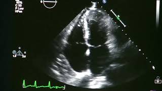 Atrial Fibrillation On Echocardiogram [upl. by Zechariah549]