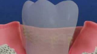 Periodontal Disease amp Treatment [upl. by Ruprecht50]