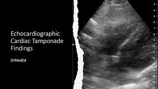 Point of Care Ultrasound POCUS Cardiac Tamponade [upl. by Geraud]