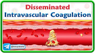 Disseminated Intravascular coagulation Animation  Pathogenesis Morphology Diagnosis Treatment [upl. by Leahsim]