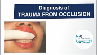 Diagnosis of TRAUMA FROM OCCLUSION TFOCLINICALRADIOGRAPHICFREMITUS TESTDR ANKITA KOTECHA [upl. by Aillicsirp]