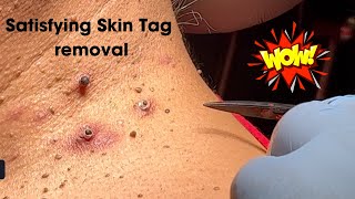 Amazing Satisfying Skin Tag Removal [upl. by Aicila]