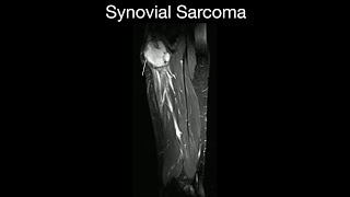 Synovial Sarcoma [upl. by Assert716]