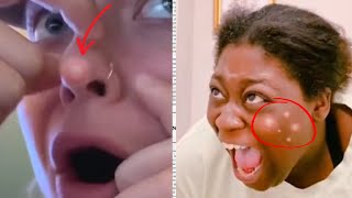 Ultimate Blackhead Removal Compilation 2024 Satisfying Extractions and Perfect Skin Tips 4 [upl. by Nylaroc]