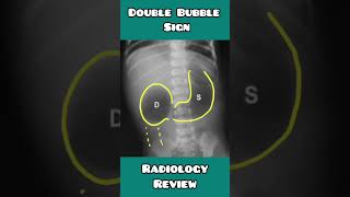 “Double Bubble Sign” in Duodenal atresia made easy for USMLE NEET PG INICET NCLEX [upl. by Vinnie737]