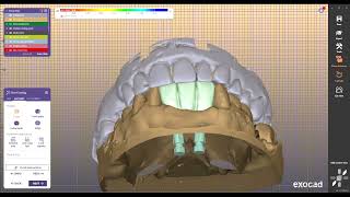 DESIGN DENTAL TEMPORARY CROWN END IBAR design exocad ampb4d ibar12 [upl. by Amrita]