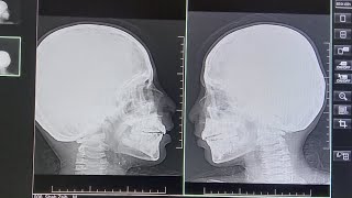 x ray Nasal bone Both Lateral view  Nose fracture  x ray position  Trauma [upl. by Rozalin343]