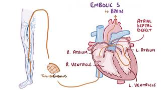 Deep vein thrombosis causes symptoms diagnosis treatment pathology [upl. by Toogood]