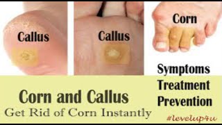 Corns And CallusesCorn And Callus DifferenceCorn TreatmentCorns And Calluses Home Remedies [upl. by Fitts564]