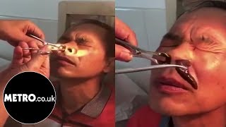 Doctor pulls gigantic live leech from mans nostril  Metrocouk [upl. by Pattie]