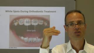 White Spots During Orthodontic Treatment by Dr Mike Mew [upl. by Finer]