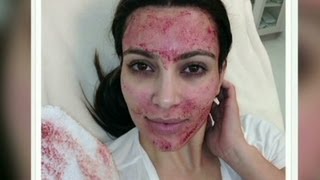 Kim Kardashian gets a vampire facial [upl. by Trella]