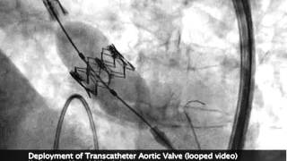 SAPIEN TAVR Deployment Under Flouroscopy Ultrasound [upl. by Lorolla]