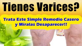 COMO QUITAR LAS VARICES DE LAS PIERNAS Remedios Caseros Para Las Varices TRATAMIENTO NATURAL [upl. by Isiad]