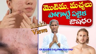 How To Remove Pimples Overnight  Acne Treatment  Dr Manthena Satyanarayana Raju  GOOD HEALTH [upl. by Sirotek]