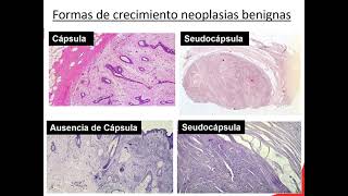 10 Neoplasias 1B Pato Anato Neoplasias Benignas vs Malignas 1 [upl. by Lleksah]