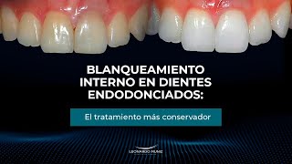 Blanqueamiento interno en dientes endodonciados el tratamiento más conservador [upl. by Sissel]