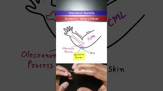 Olecranon Bursitis orthopedics inicet neetpg [upl. by Blanca]