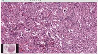 Adenomatoid Tumor  Histopathology [upl. by Vig]