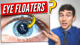 3 Must Know Facts About EYE Floaters [upl. by Antone]