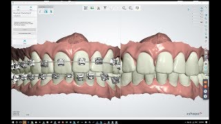 How To Use 3Shape Indirect Bonding Software with the BioQuick Bracket System [upl. by Drobman]