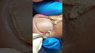 how to remove ingrown [upl. by Gentilis]