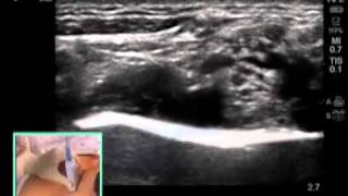 ULTRASOUNDGUIDED SUPRACLAVICULAR NERVE BLOCK [upl. by Assilram]