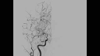 Moyamoya vasculopathy in a patient with newonset coma [upl. by Nyahs]