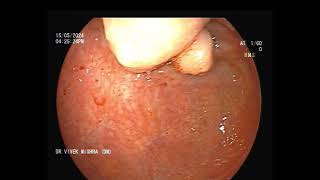 कोलोनोस्कोपी करने पर मिला बड़ी आंत में गांठ  Colonic polypoidal lesion at cecum  GASTROLIVER [upl. by Uokes]