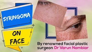 Treatment of syringoma by Facial plastic surgeon in Kerala [upl. by Eshelman]