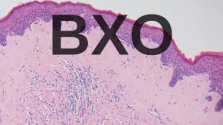 Balanitis Xerotica Obliterans BXO  Pathology mini tutorial [upl. by Akyssej100]