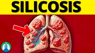 What is Silicosis EXPLAINED [upl. by Eyahs316]