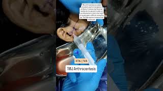 TMJ Arthrocentesis For TMJ Pain Relief  Dr Parit Ladani [upl. by Vasya]