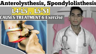 Anterolisthesis spondylolisthesis L5s1 spondylolisthesis Treatment Exercise Low back pain [upl. by Akirdna]