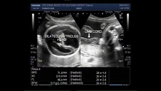 Dilated fetal ventricles Ventriculomegaly also known as hydrocephalus [upl. by Trin]