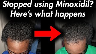 This happens when quitting Minoxidil Experiment [upl. by Calore]