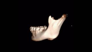 Green stick fracture of the mandibular condylar neck [upl. by Nolaj]