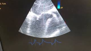 Échographie TransOesophagnienneETO Sténose Mitrale Maladie Aortique au Cameroun 25 ans Siemens [upl. by Ireg]